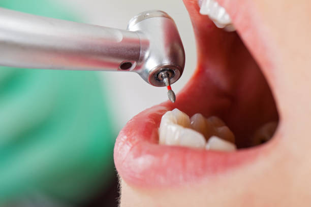 Best Dental Abscess Treatment in Decatur, IN